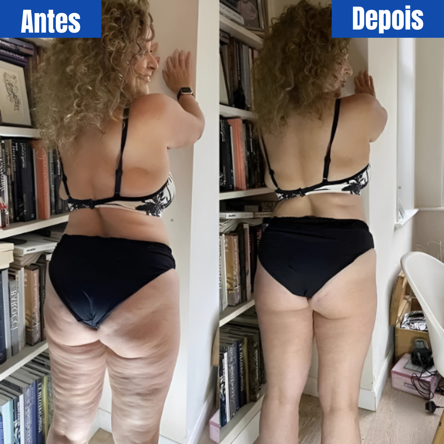 Celulite? Nunca Mais. Conheça o DermaLiss™