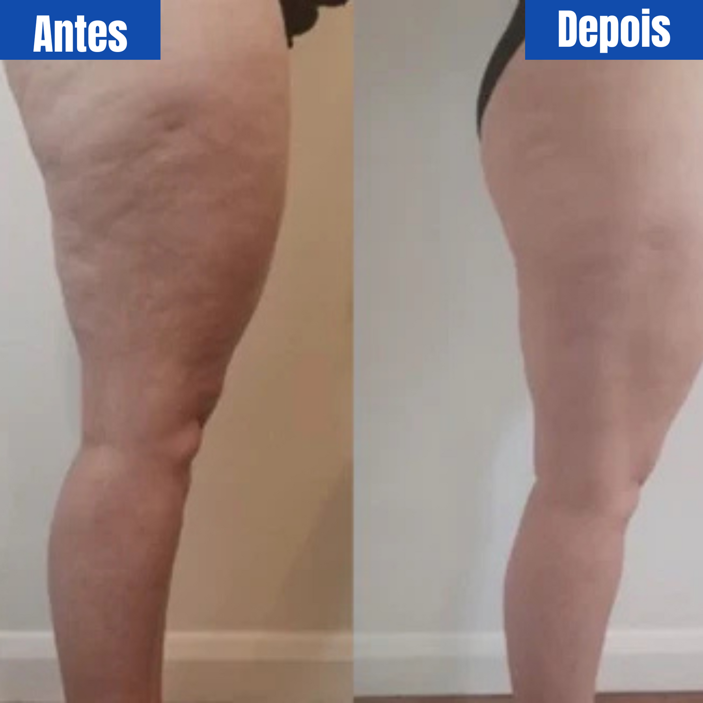 Celulite? Nunca Mais. Conheça o DermaLiss™