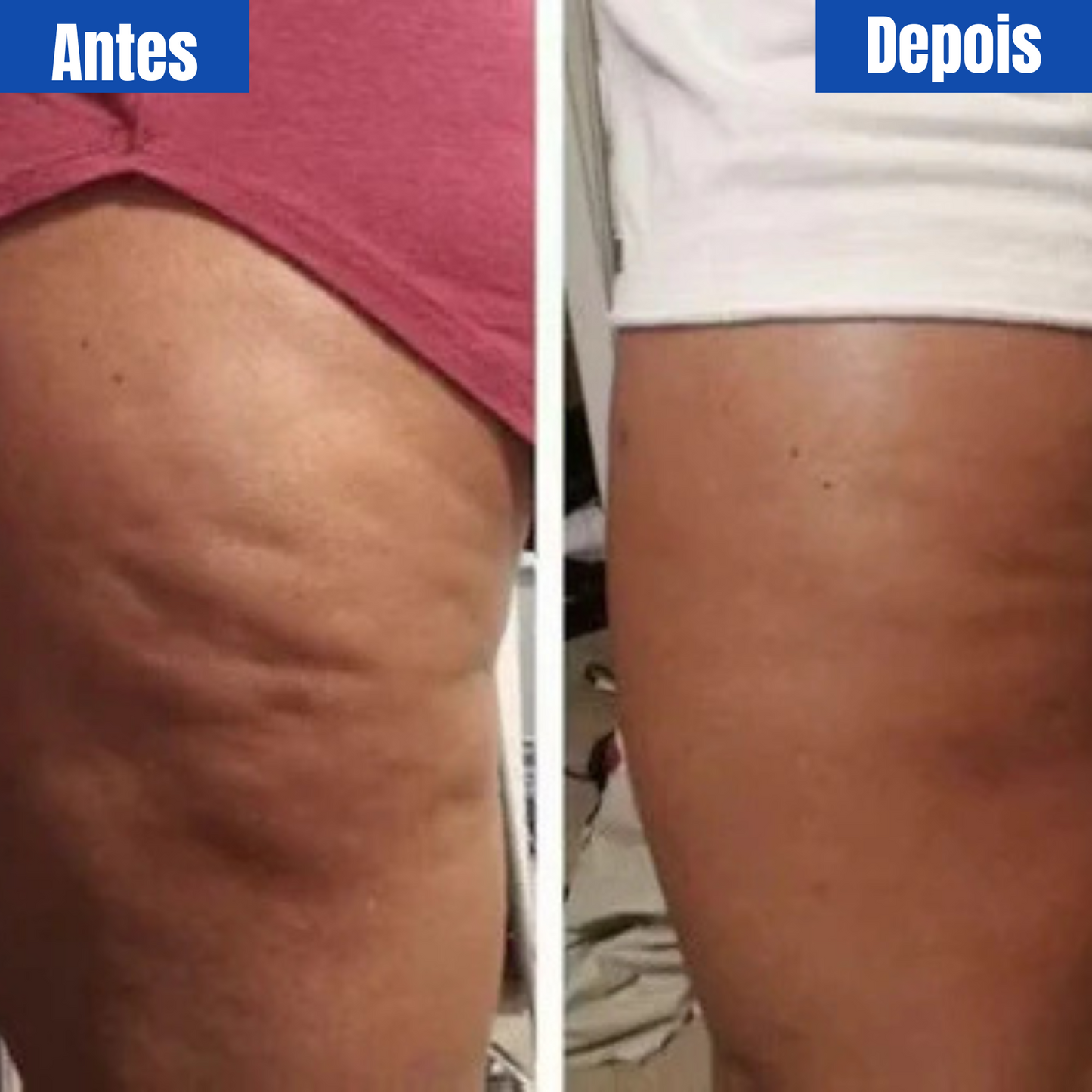 Celulite? Nunca Mais. Conheça o DermaLiss™